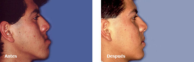 Cirugia Maxilofacial-Deformidades Dentofaciales Prognatismo