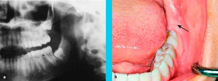Muelas del Juicio - Terceros Morales