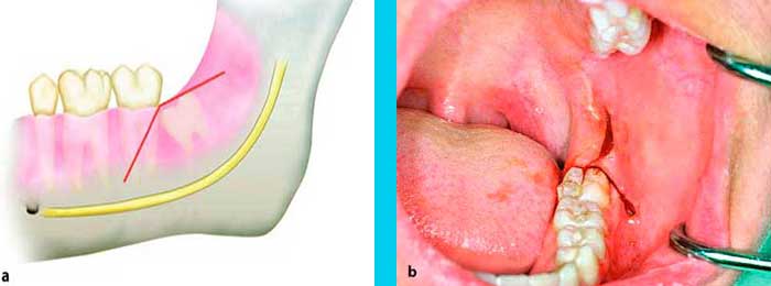 Muelas del Juicio maxilofacial
