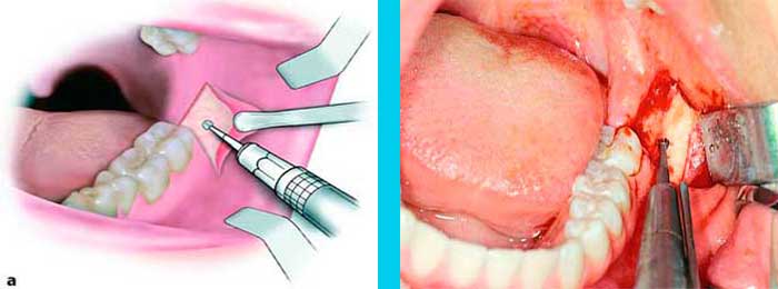 Muelas del Juicio Cirugia