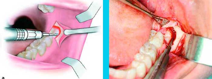 Muelas del Juicio Ejemplos