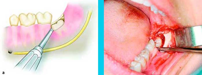 Muelas del Juicio Cirujano Maxilofacial