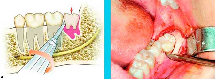 Muelas del Juicio Dr. Molina Moguel