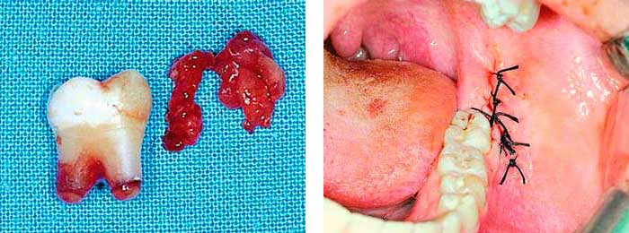 Muelas del Juicio Extraccion