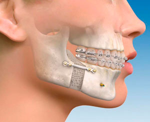 Especialista cirujano maxilofacial muelas del juicio