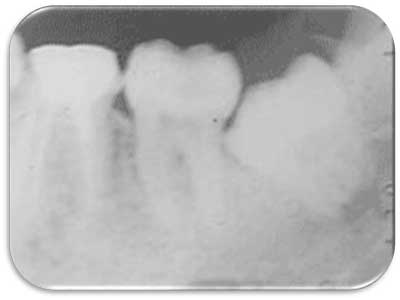 Radiografia periapical muelas del juicio