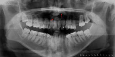 Ortopantomografia muelas del juicio