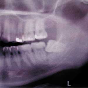 Caries muelas del juicio