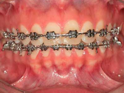 Ortodoncia muelas del juicio