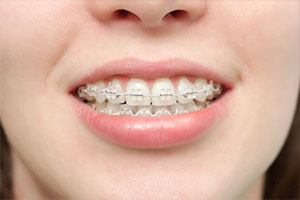 Brackets Esteticos