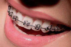 Brackets Metalicos