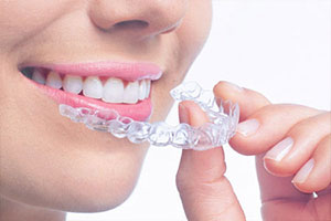 Invisalign