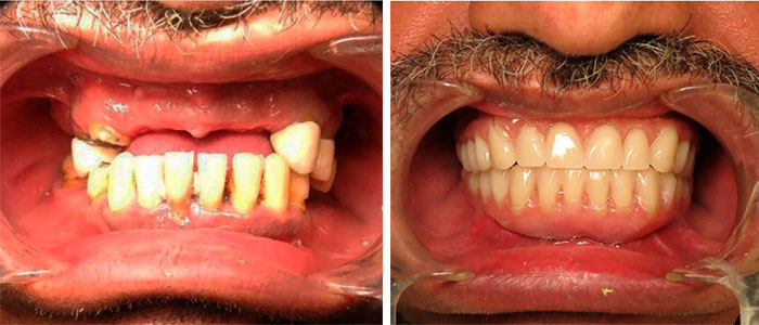 Implantes Dentales All on 4 - Antes - Después