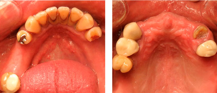 Implantes Dentales All on 4 Antes
