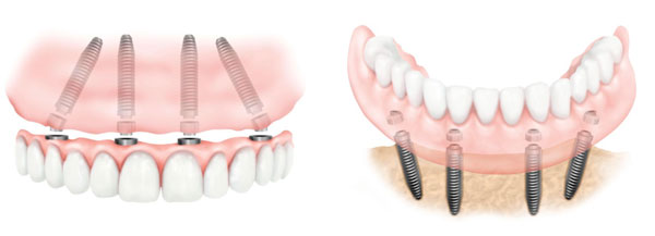 Implantes Dentales All on Four Inferior y Superior