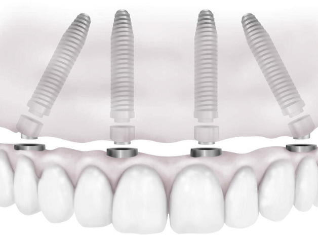 Implantes Dentales All on Four