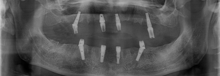 Radiografía Panorámica