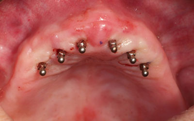Mini Implantes Dentales