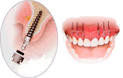 Mini Implantes Dentales