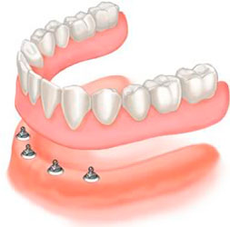 Mini Implantes Dentales