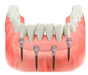 Mini Implantes Dentales