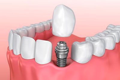 Implantes Dentales Unitarios