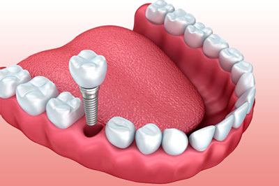 Implantes Dentales