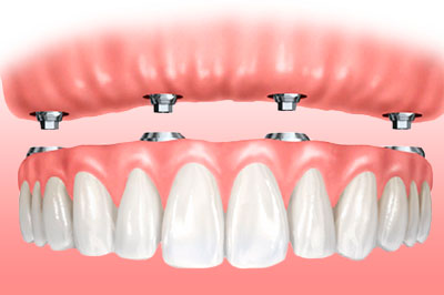 Implantes Dentales All on Four