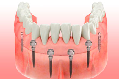 Mini Implantes Dentales