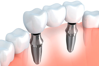 Puente con Implantes Dentales