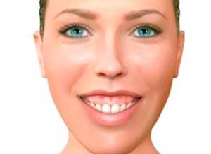 Sonrisa Gingival