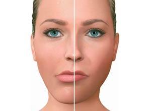 Asimetría Facial