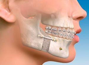 Tratamientos - Cirugia Maxilofacial