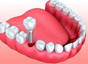 Tratamientos - Implantes Dentales