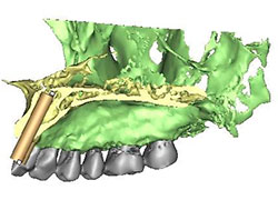Planificación de implantes