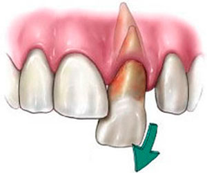 Avulsión Trauma Alveolar