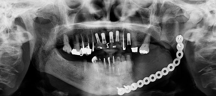 Bifosfonato Implantes dentales