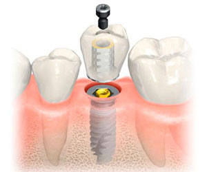 Carga Inmediata Implantes Dentales