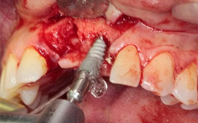 Caso Clínico Implantes con carga inmediata