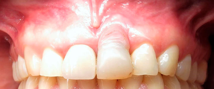 Distracción Alveolar Histogénica