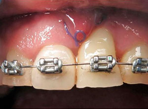 Distracción Alveolar Histogénica