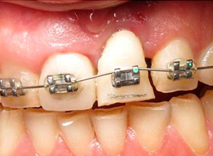 Distracción Alveolar Histogénica