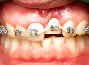 Distracción Alveolar Histogénica