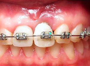 Distracción Alveolar Histogénica