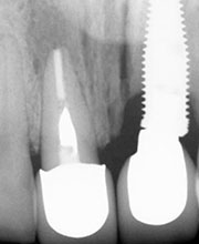 Distracción Alveolar Histogénica