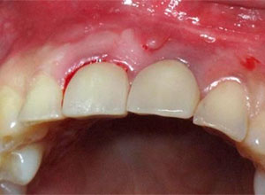 Distracción Alveolar Histogénica