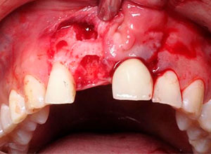 Distracción Alveolar Histogénica