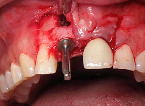 Distracción Alveolar Histogénica