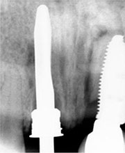 Distracción Alveolar Histogénica