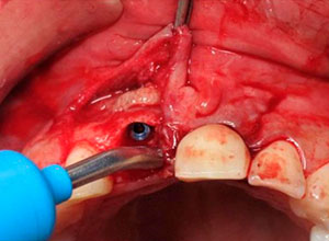 Distracción Alveolar Histogénica